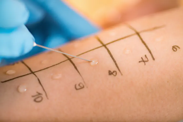 Prueba del prick en el antebrazo para el diagnóstico de alergias al polen en la consulta médica